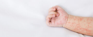 Picture of a baby's hand for release about MMR vaccine.