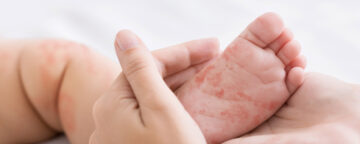 Photo of baby's foot with red measles rash. For a story about the MMR vaccine.